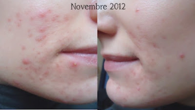 La crème de beauté pour enlever les époques élargies